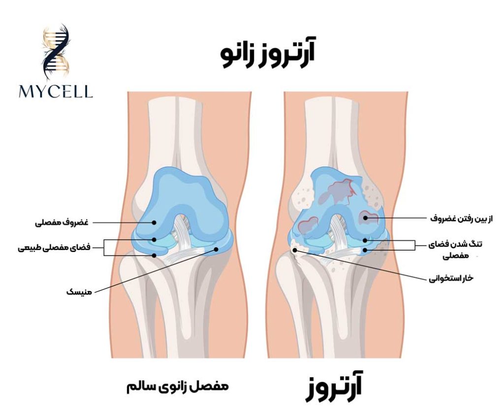 درمان آرتروز زانو