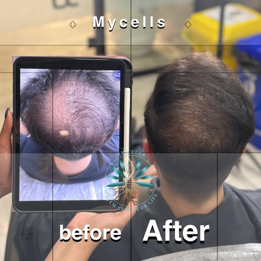 نمونه درمان ریزش مو در مایسل مشهد