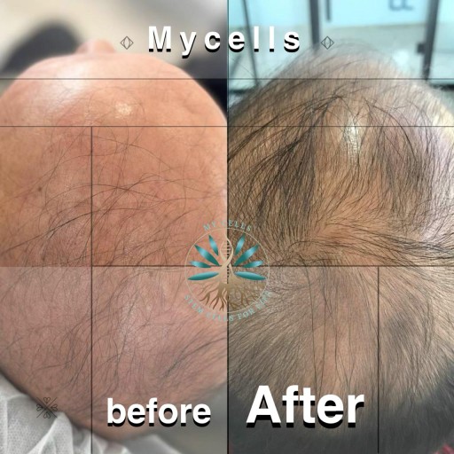 نمونه درمان ریزش مو در مایسل مشهد