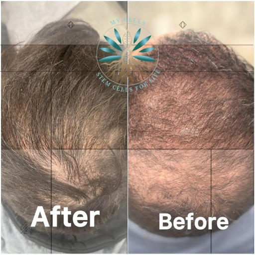 نمونه درمان ریزش مو در مایسل مشهد