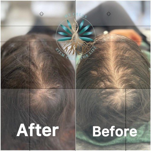 نمونه درمان ریزش مو در مایسل مشهد