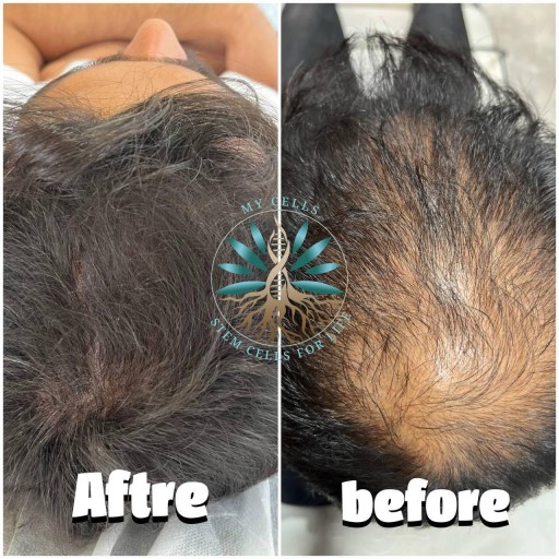 نمونه درمان ریزش مو در مایسل مشهد