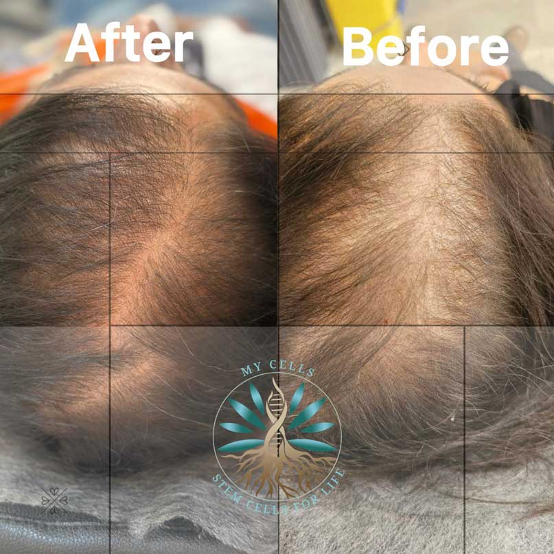 نمونه درمان ریزش مو در مایسل مشهد